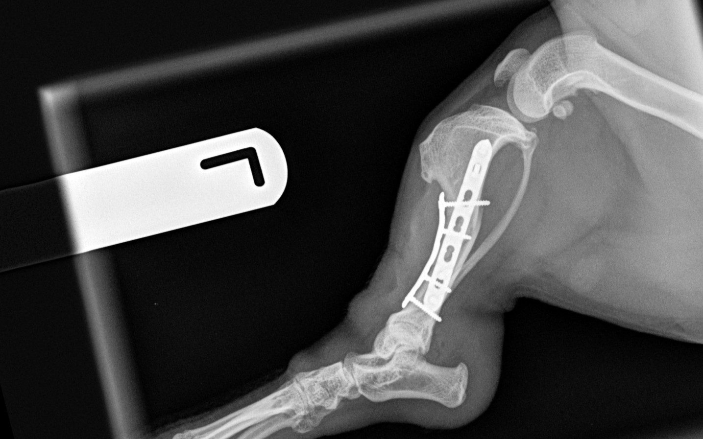 Case 05 — Bonnie — Tibia fracture — orthogonal double plating