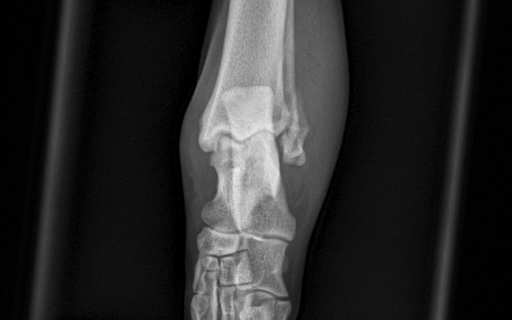 Case 02 — Buddy — Lateral malleolus fracture