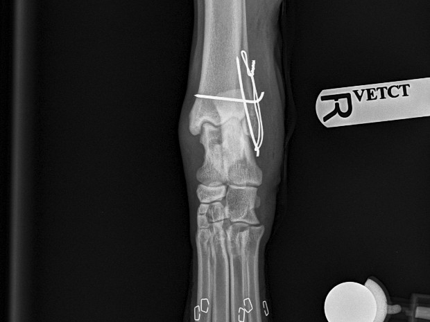 Post-op cd-cr view showing pin, tension band and skin staples