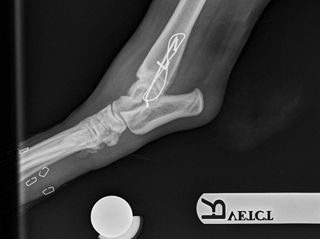 Post-op lateral view showing pin and figure-of-8 tension band
