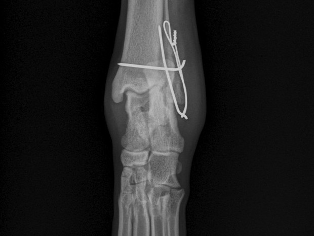 6 weeks post-op cd-cr view