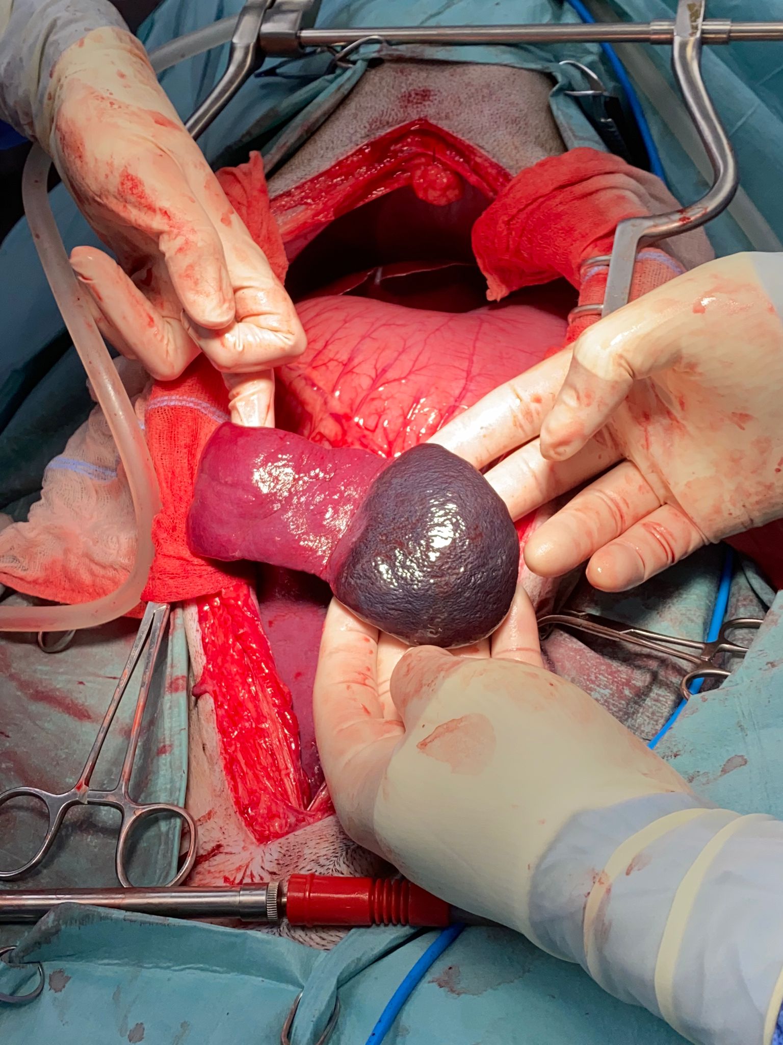 Splenic congestion