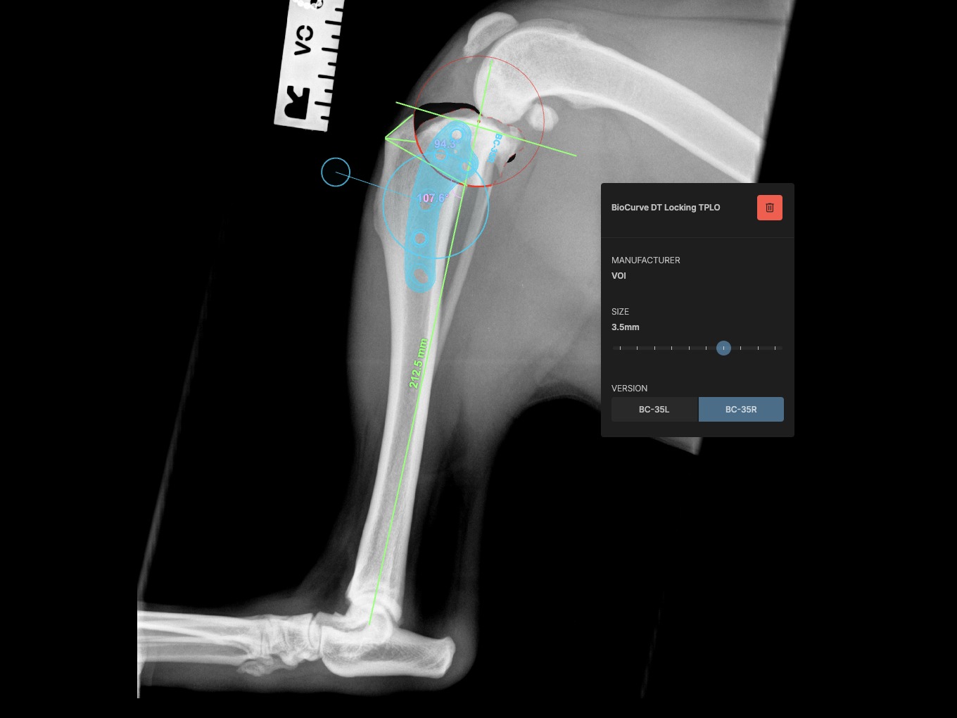 Surgical planning, lateral view