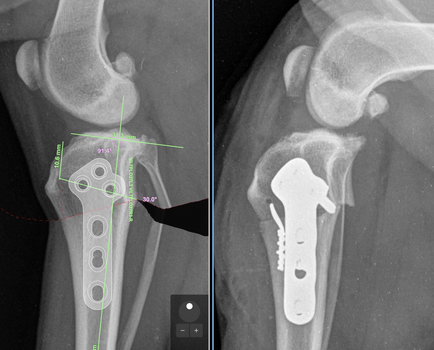 CCWO surgical procedure