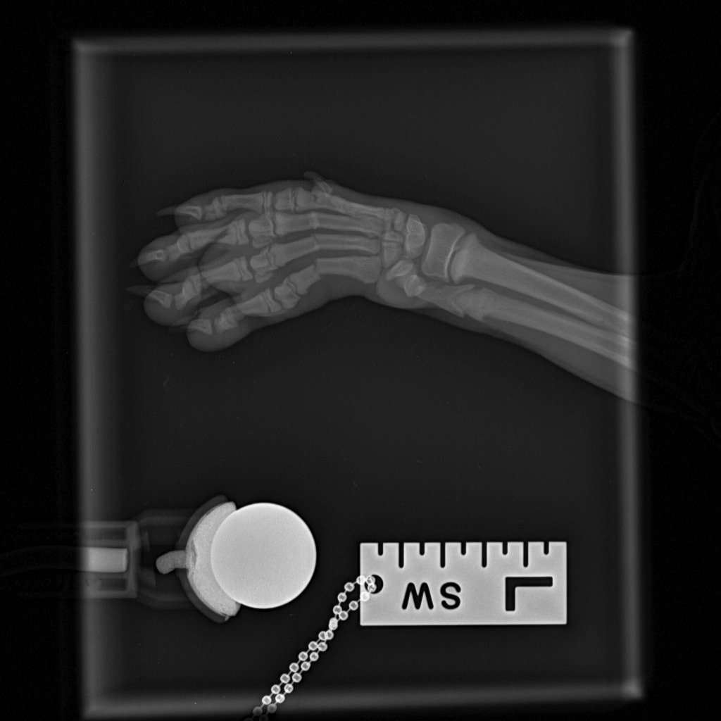 Pre-operative carpal X-ray