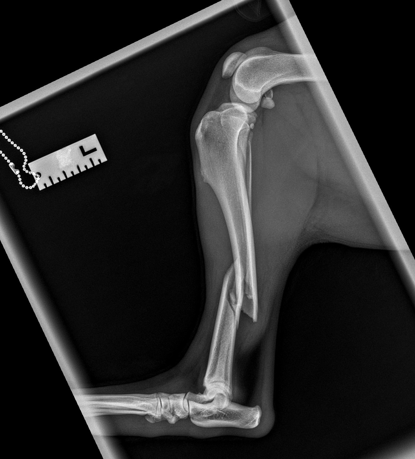 Lateral tibia fracture X-ray — Ben
